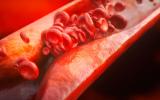 Nanopartículas detectan precozmente la aterosclerosis
