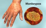 Ampollas en la mano características del contagio por viruela del mono