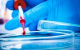 Biopsia líquida para detectar el cáncer de colon