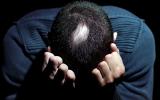Persona con alopecia areata y síntomas de ansiedad