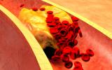 Arteria taponada por el colesterol