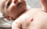 Bebé con un hemangioma en el pecho