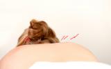 Espalda de mujer con agujas de acupuntura