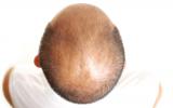 Caballero con alopecia areata
