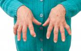 Edad avanzada, causas de la artritis reumatoide 