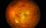 Retina afectada por retinosis pigmentaria