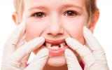 Diferencias entre la dentición temporal y la definitiva