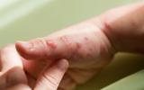Médico examinando la mano de un niño afectado por el herpes zóster