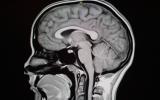 Diagnóstico de la neuralgia del trigémino
