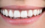 La ortodoncia invisible es una opción más cómoda, higiénica y estética que la té