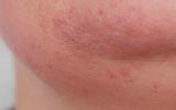 Síntomas de la alergia al huevo en la piel
