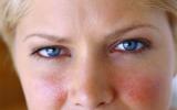Síntomas de la rosácea en la cara de una mujer