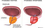 Tipos de prostatitis