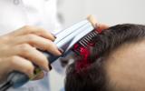 Microinjertos de pelo y plasma enriquecido para la alopecia