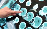 Radiografía del cerebro indicando un posible caso de de alzhéimer