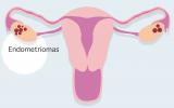 Endometriomas