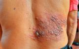 Espalda de un anciano con una infección por el virus del herpes zóster