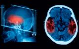 Tomografía de un cerebro con un ictus