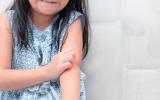 Diagnóstico, tratamiento y aceptación: el reto de la psoriasis infantil