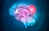 Un nuevo tratamiento de la hemorragia cerebral demuestra eficacia
