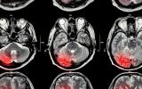 Escáner del cerebro mostrando un glioblastoma o tumor cerebral