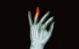 Radiografía de fractura de dedo