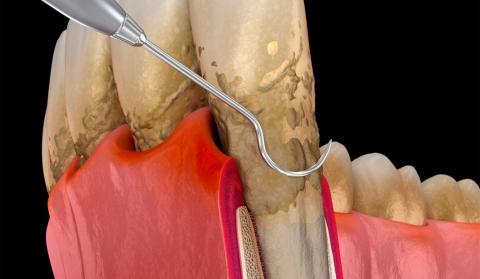Infografía de un raspado dental para eliminar sarro