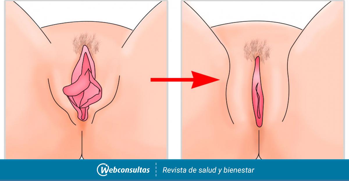 La labioplastia o ninfoplastia es una cirugía estética genital que consiste...