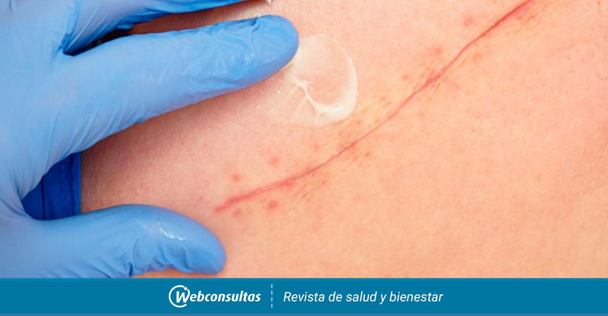 Recomendaciones Para Cuidar La Cicatriz De La Cesarea