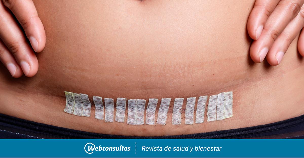 Complicaciones En La Cicatrizacion De La Cesarea
