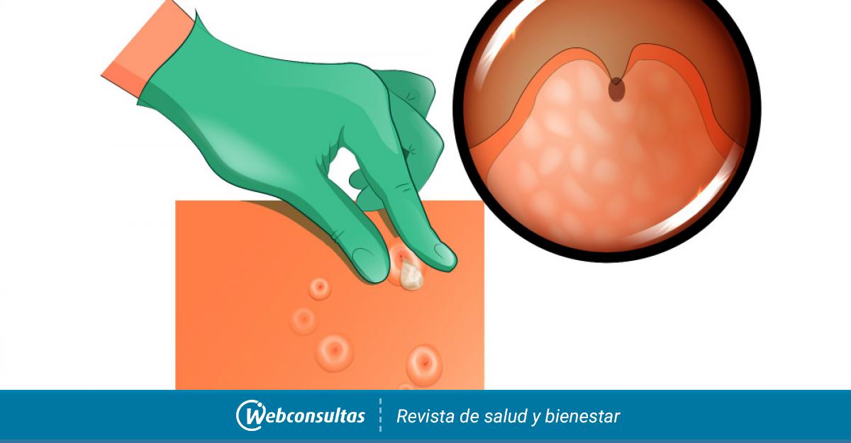Diagnostico Del Molusco Contagioso Como Detectarlo