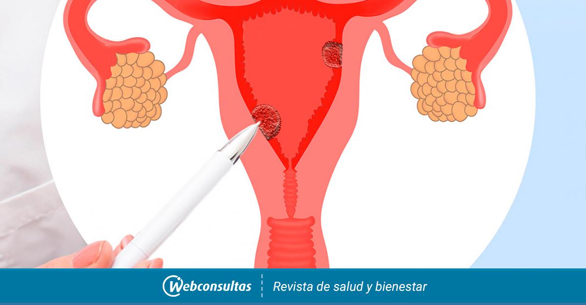Pólipos uterinos Causas, síntomas y tratamiento