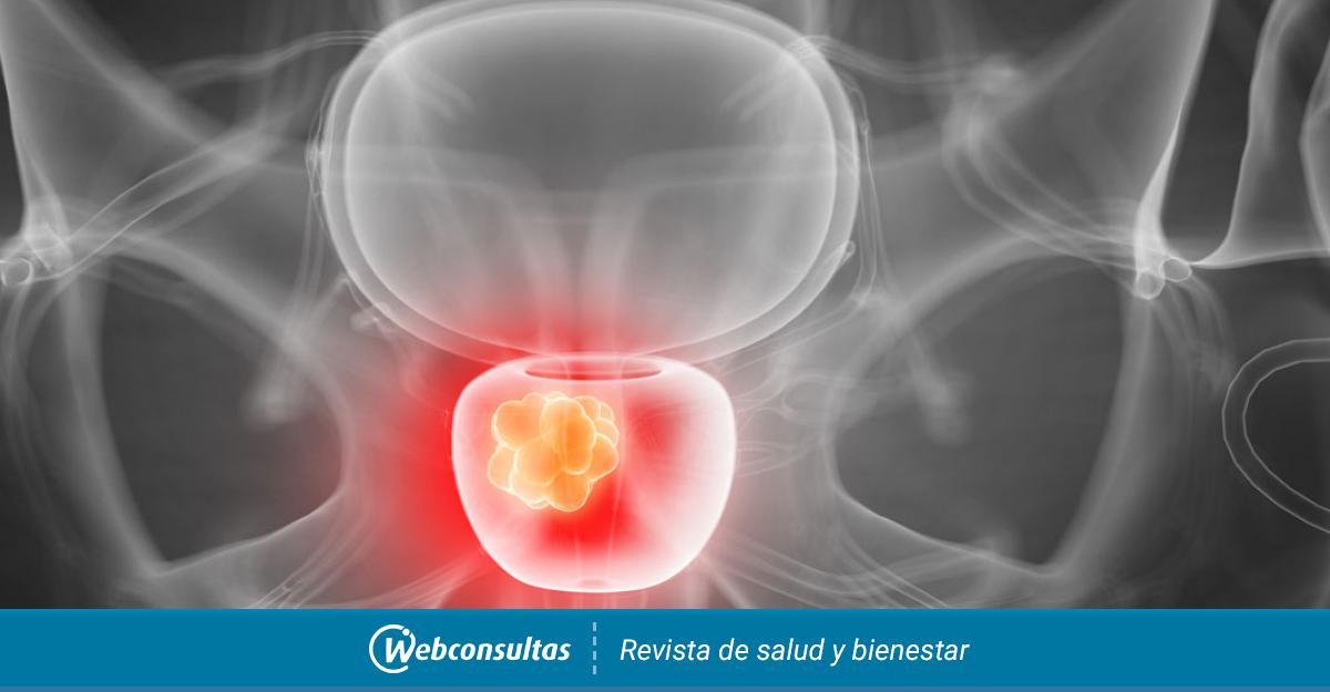 cancer prostata terapia hormonal)