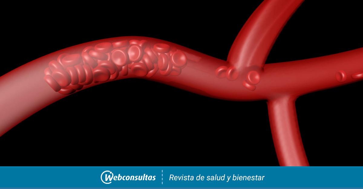 Trombosis Venosa Cerebral Que Es Sintomas Y Tratamiento
