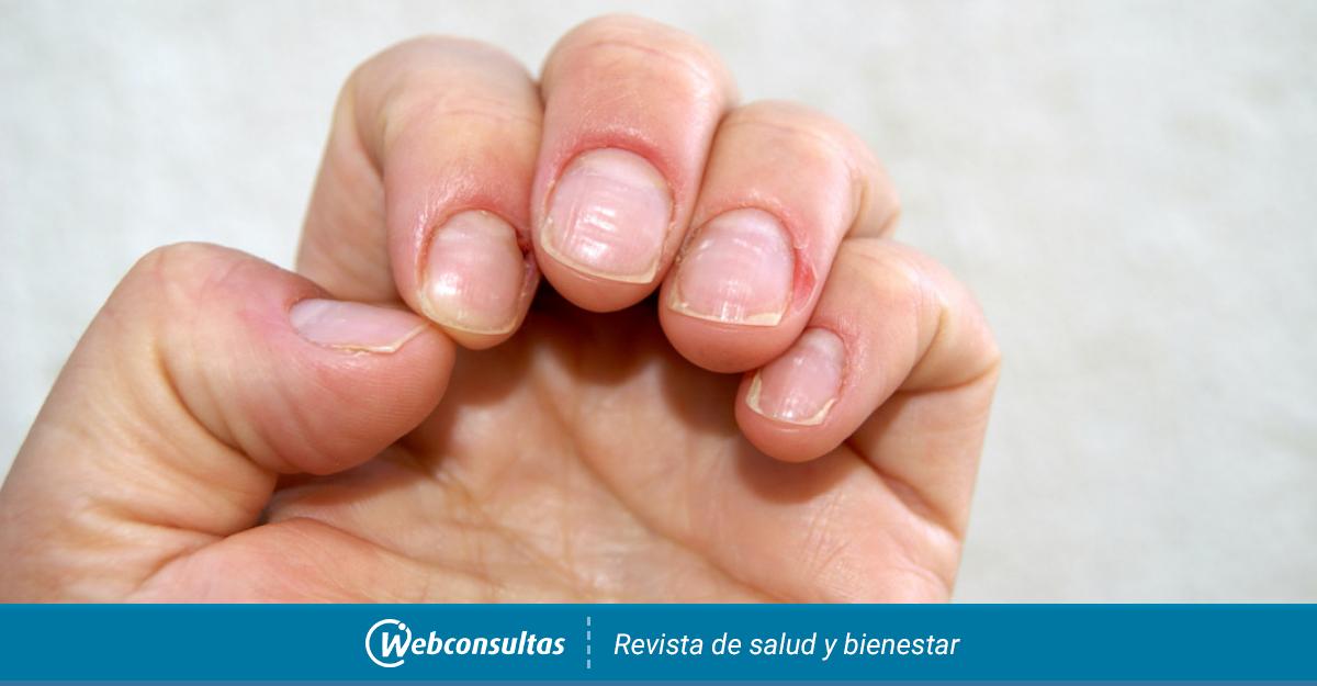 Prevenir y tratar las estrías en las uñas   Blog Druni