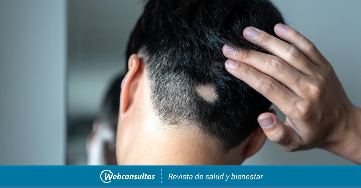 Un fármaco hace el pelo el 40% de pacientes