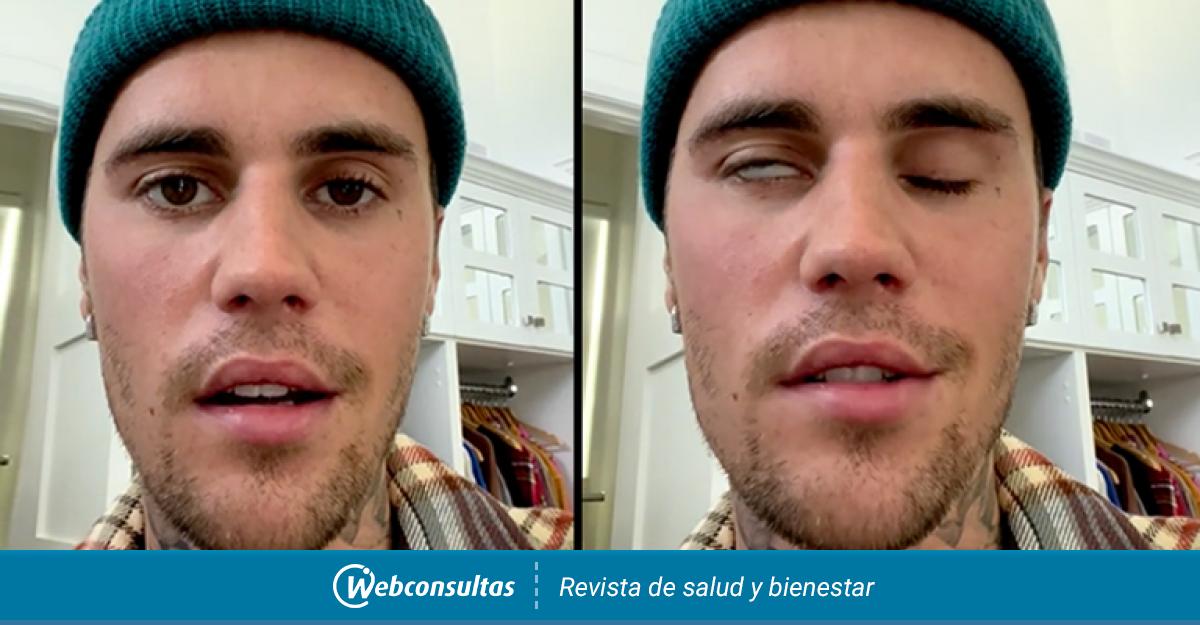 Síndrome Ramsay Hunt, ¿qué le pasa a Justin Bieber? Síntomas