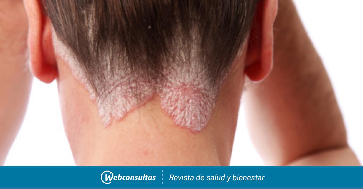Seborrhoeás dermatitis és psoriasis kezelések és fotó