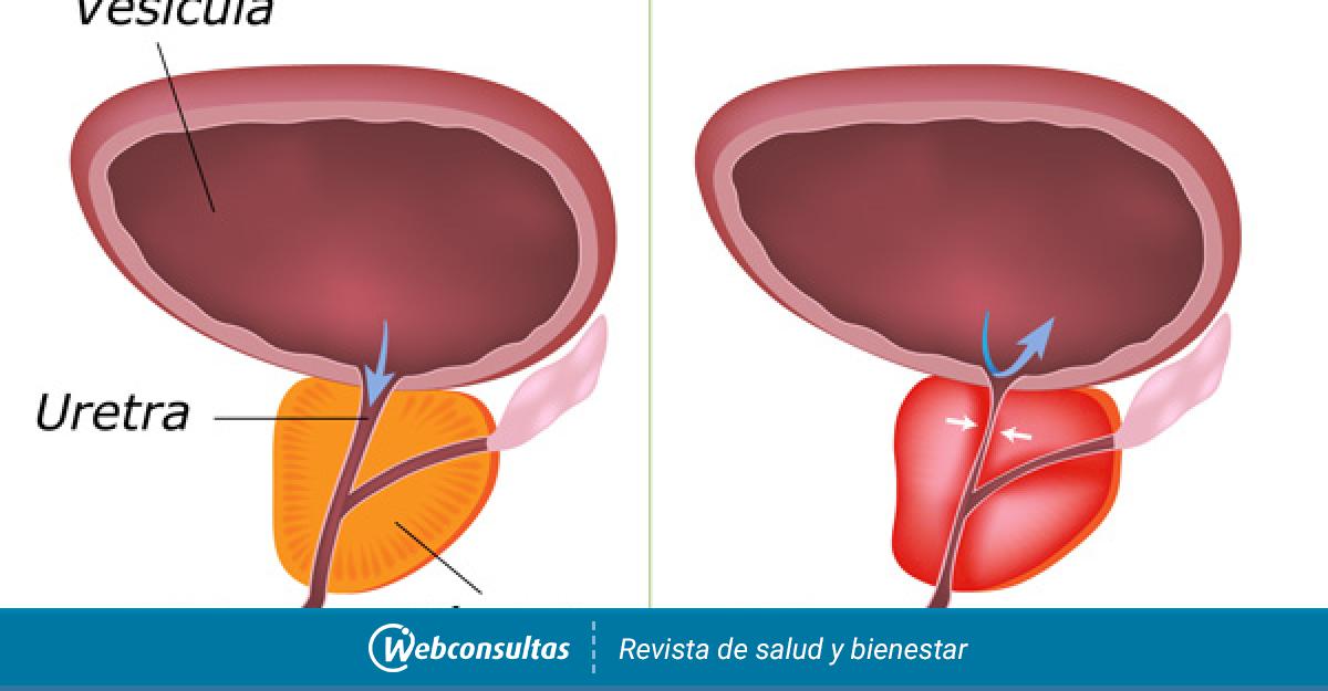cancer de prostata recidiva bioquimica