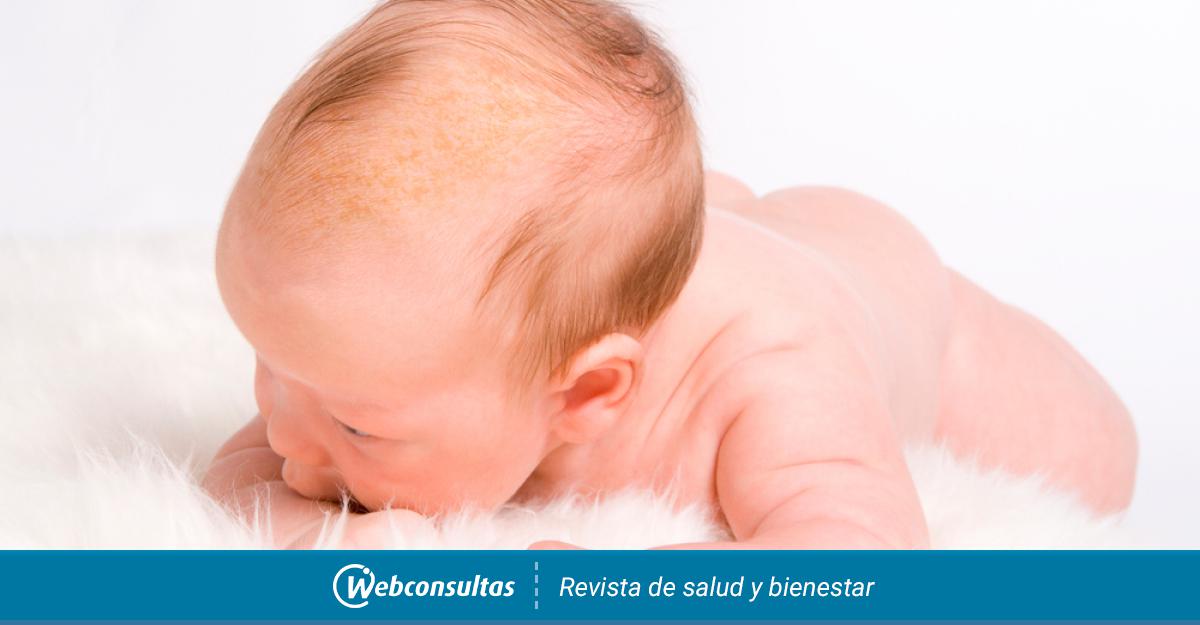 Costra láctea, cómo tratar la dermatitis seborreica del bebé