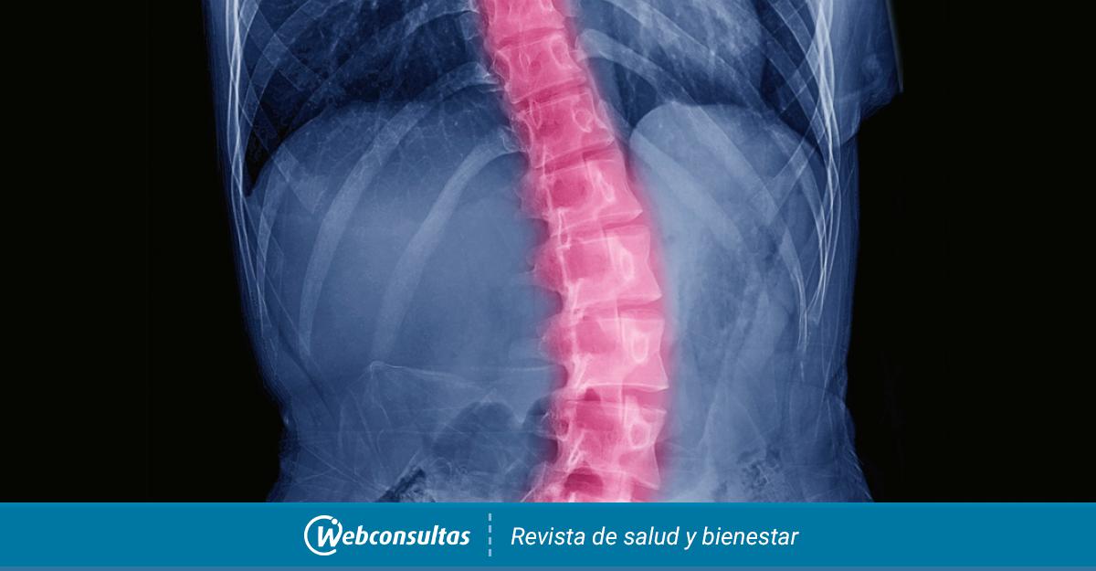 FisioFlex - ➡LA ESCOLIOSIS es una desviación de la columna vertebral, que  en lugar de estar recta se tuerce y se curva hacia un lado. Si la columna  vertebral está muy desviada