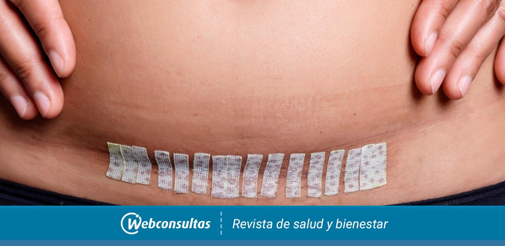 Complicaciones En La Cicatrizacion De La Cesarea