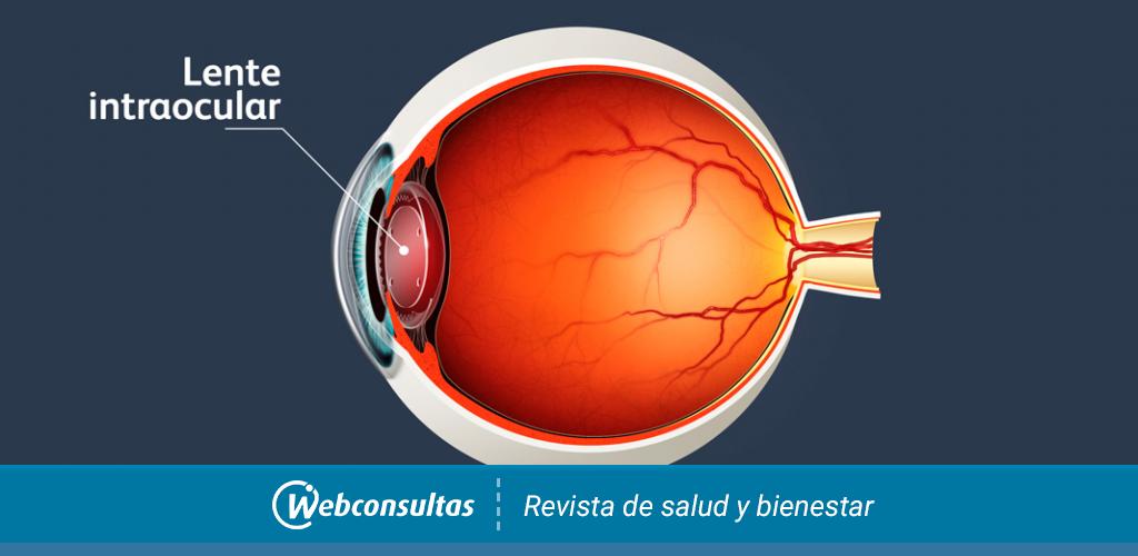 Lente intraocular presbicia online