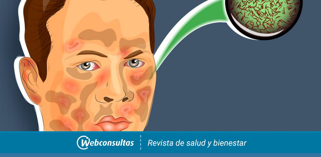 Infección por Lepra: Origen, manifestaciones clínicas y tratamiento -