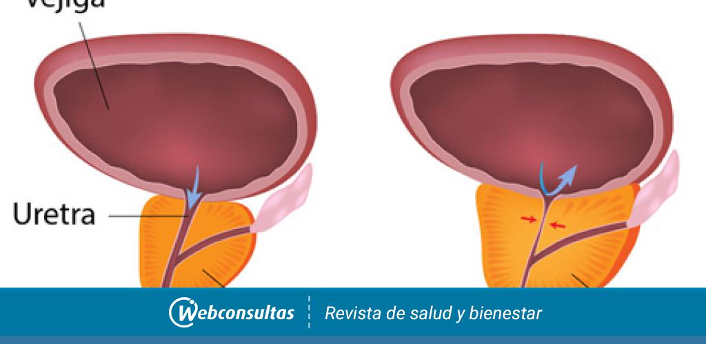 Hiperplasia benigna de próstata síntomas y tratamiento