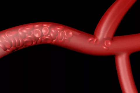 AstraZeneca: ¿Qué es la trombosis venosa cerebral? ¿Qué es la trombosis venosa cerebral?