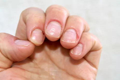 Uñas COVID tras pasar el coronavirus: qué indican Uñas COVID tras pasar el coronavirus