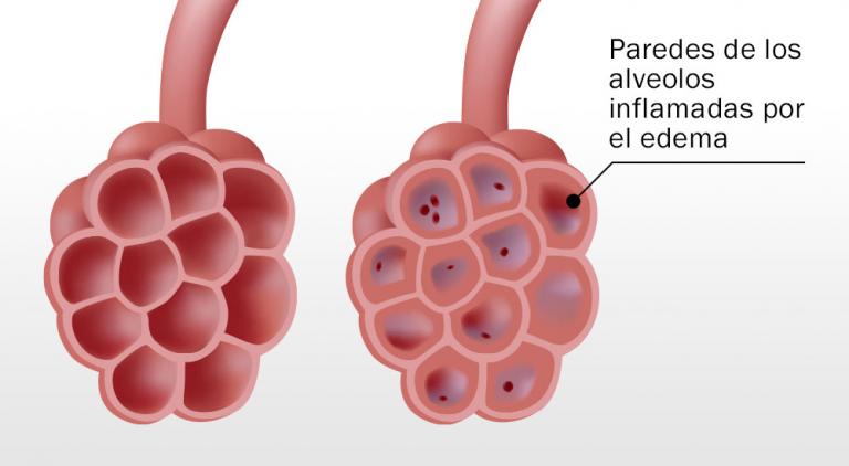 Ilustración de los tipos de edema pulmonar