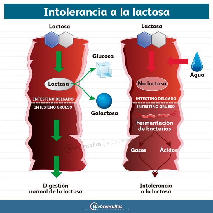 Infografía Intolerancia a la lactosa