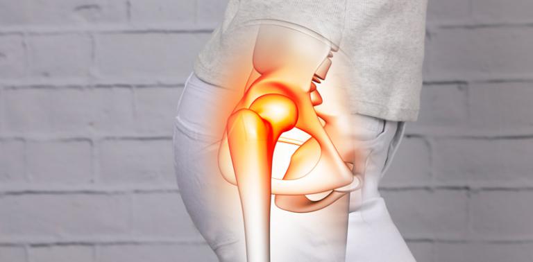 Concepto artrosis en la cadera